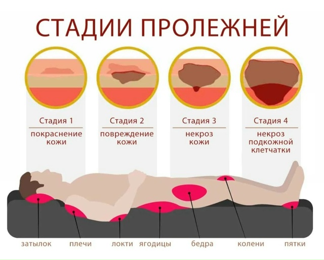 Стадии пролежней Стадии пролежней